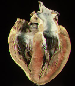 Subendocardial Infarct