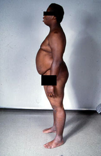 Pregnant spondylolthesis