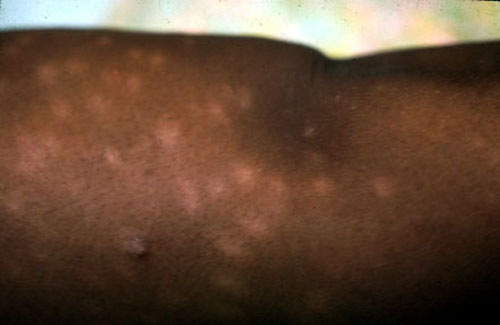 Lesions: When a lesion is detected describe the type, color