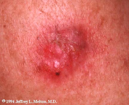 Nodular melanoma - Wikipedia