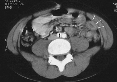 férgek és mesenterialis adenitis in)