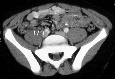 férgek és mesenterialis adenitis in