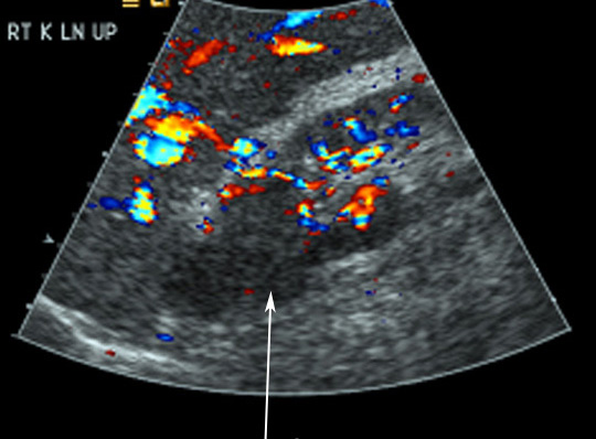 What is a kidney mass?