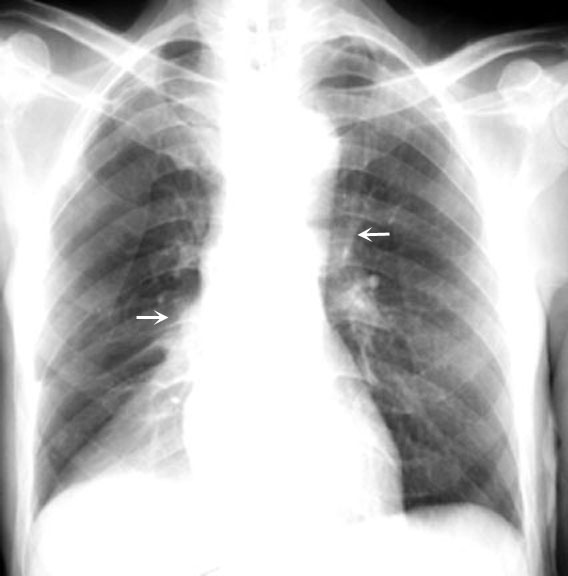 The right hilum and transverse fissure are pulled down (loss of lung