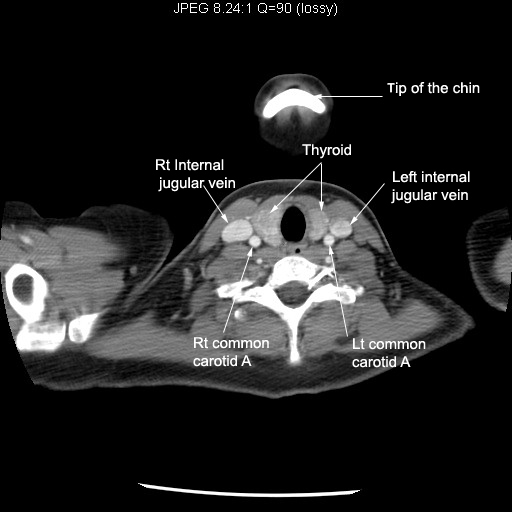 Internal jugular vein joins subclavian vein to form brachiocephalic vein