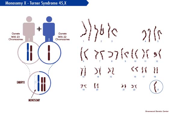 LUMEN - Genetics diagram of turner syndrome 
