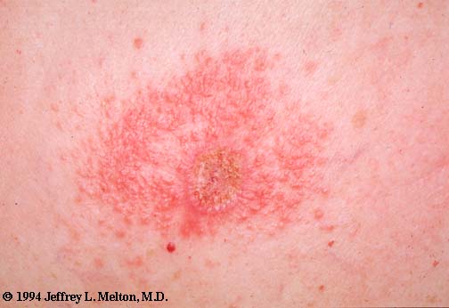 Contact dermatitis (Neomycin)