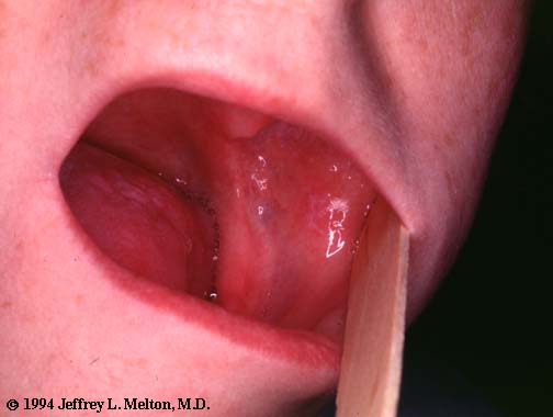 Oral lichen planus: An update on pathogenesis and treatment