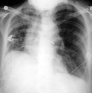 Cxr quiz image
