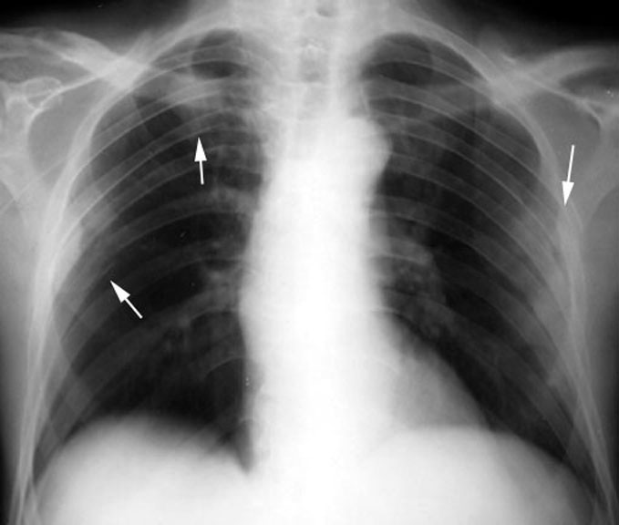 Rib Metastasis