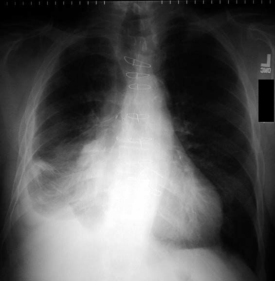 mesothelioma prevalence