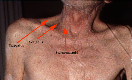 http://www.lumen.luc.edu/lumen/MedEd/medicine/pulmonar/images/copd1l.jpg