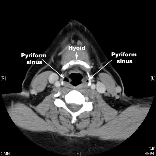 identify pyriform sinus and hyoid