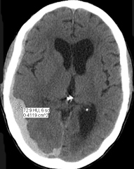 Vs hematoma epidural hematoma subdural Epidural and