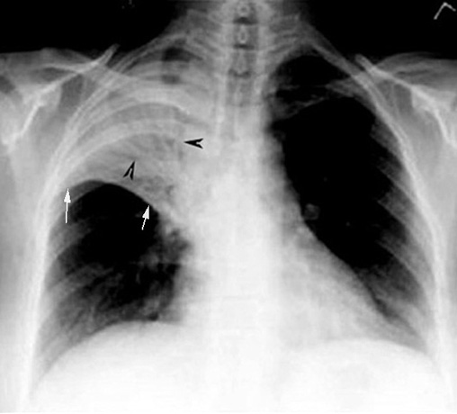 No significant loss of lung No significant loss of lung