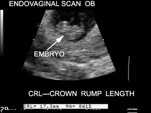 crown rump length pregnancy dating The journal of maternal-fetal & neonatal medicine volume 28, 2015 - issue 1 submit an article journal keywords:crown rump length, early pregnancy dating,. crown rump length pregnancy dating The journal of maternal-fetal & neonatal medicine volume 28, 2015 - issue 1 submit an article journal keywords:crown rump length, early pregnancy dating,.