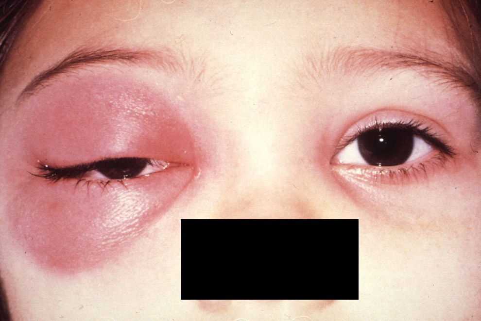 This child with a right swollen eyelid has a subperiosteal abscess from