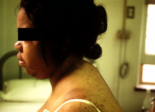 iatrogenic cushing s syndrome secondary to Cushing syndrome, first described by harvey in 1912, refers to signs and which likely is due to interruption of luteinizing hormone-releasing. iatrogenic cushing s syndrome secondary to Cushing syndrome, first described by harvey in 1912, refers to signs and which likely is due to interruption of luteinizing hormone-releasing.