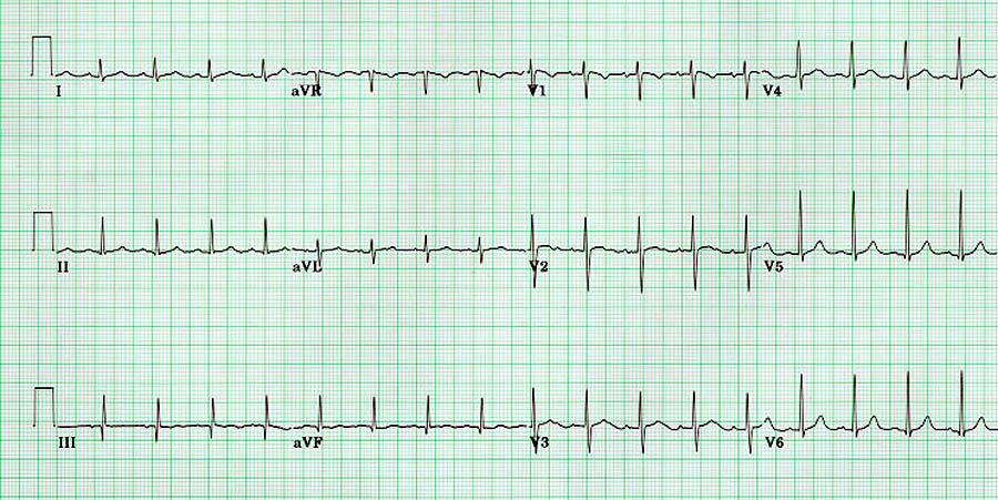 New Q waves: From the absence of depolarization current in the dead tissue 