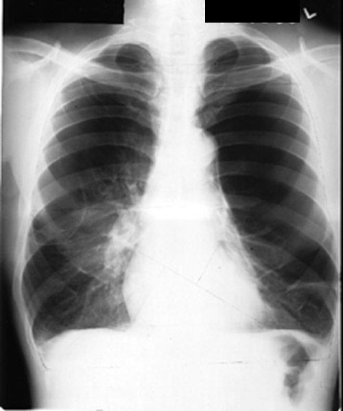 Case Chronic bronchitis Case Chronic bronchitis
