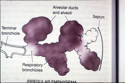 copd diagram of lung copd 