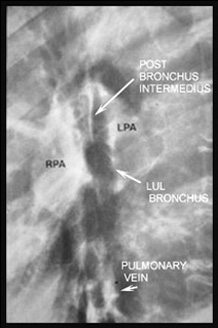 Image Of Sarcoidosis Lateral Chest Radiograph