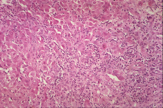 Reaction to Injury - Inflammation
