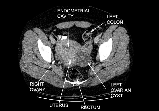 Esempio di RMI con ciste ovarica sinistra Teratomi ovarici e cisti dermoidi