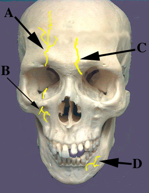 Нервы лицевого черепа. Тройничный нерв анатомия на черепе. Тройничный нерв отверстие в черепе. Подглазничный нерв на черепе.