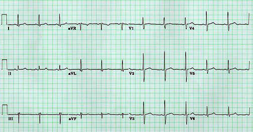 ekg1.jpg (36994 bytes)