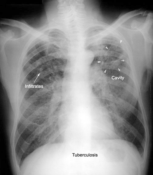 Cavity in Chest xray / Radiology