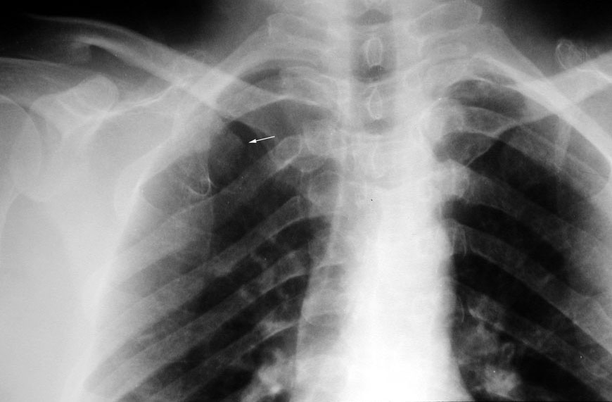 Делают рентген грудной клетки ребенку. Обызвествление 1 ребра рентген. Остеома ключицы рентген.