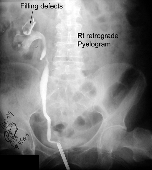 Retrograde pyelogram