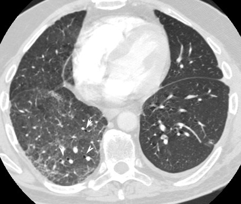 Bronchiectasis Revision Notes | Epomedicine