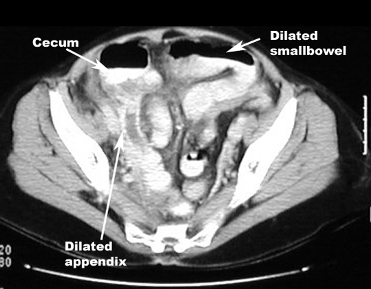 Appendicitis