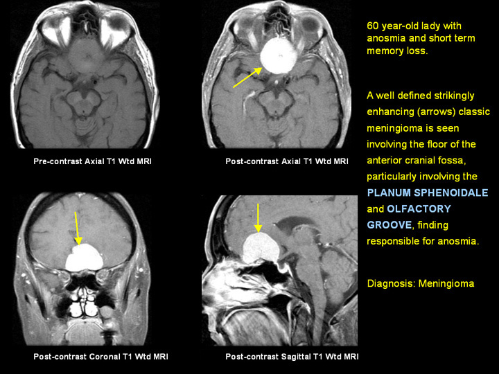 Parasagittal Meningioma Parasagittal Meningioma