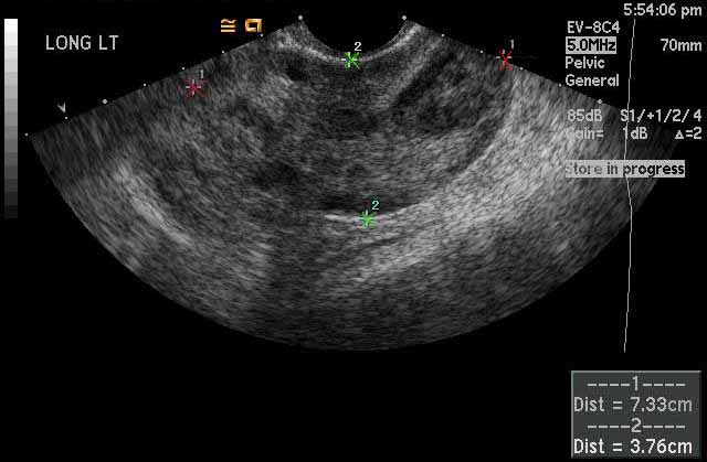 intermittent ovarian torsion