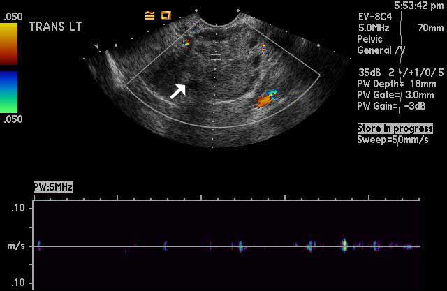 intermittent ovarian torsion