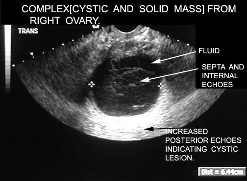 Ovarian Cysts and Other Benign Ovarian Masses - Women's Health